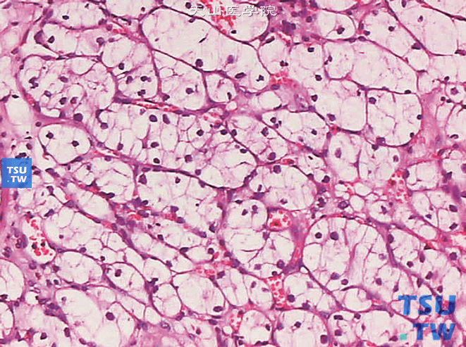 肾透明细胞型肾细胞癌，示泡巢状结构