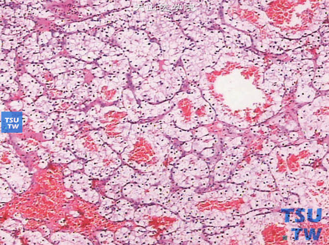 肾透明细胞型肾细胞癌，间质为薄壁血管构成的网状结构