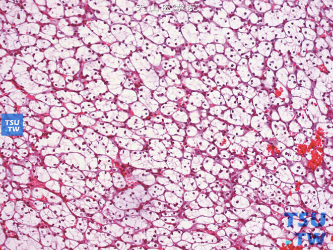 肾细胞癌，透明细胞型，1级。核小，大小如成熟的淋巴细胞，染色质多，难以看清染色质的微细特点，无核仁