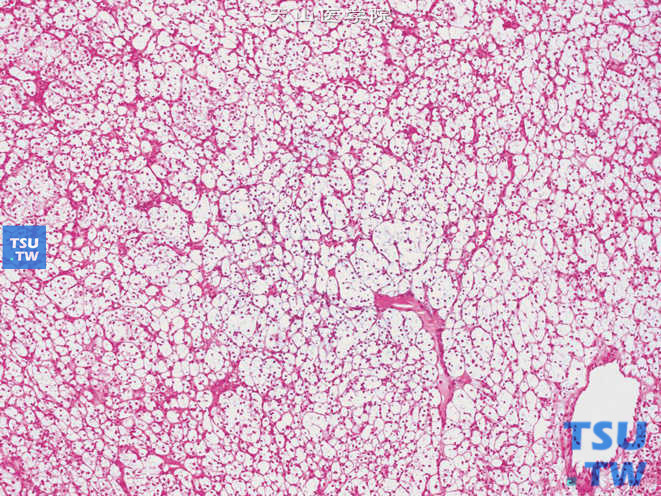 肾细胞癌，透明细胞型，间质为薄壁血管
