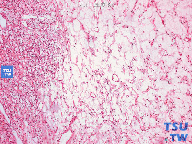 肾细胞癌，透明细胞型，1级，可见细胞疏松区
