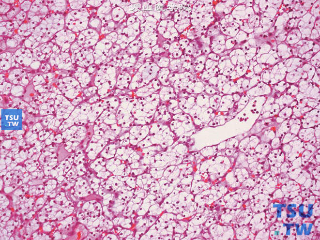 肾细胞癌，透明细胞型，1级。细胞排列成泡巢状，间质为薄壁血管