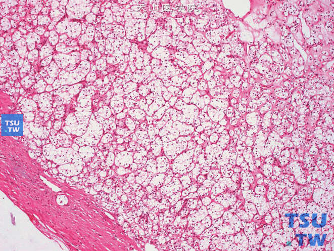 肾细胞癌，透明细胞型，示肿瘤的泡巢状结构及假包膜