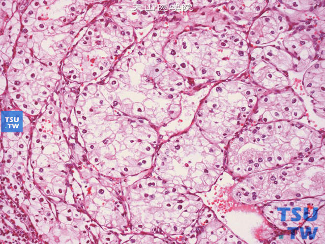 肾细胞癌，透明细胞型，2级。高倍镜示核染色质呈细颗粒状，核仁小，不明显