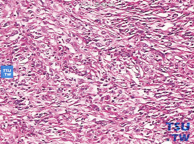 肾透明细胞型肾细胞癌G3，伴肉瘤样分化，瘤细胞呈梭形，胞质透明或嗜酸，核分级高
