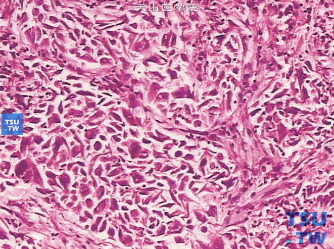 肾细胞癌，G3，伴肉瘤样分化。瘤细胞呈梭形，可见奇异核细胞
