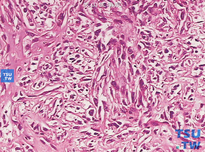 透明细胞型肾细胞癌G3，伴肉瘤样分化。细胞分化差，核分裂象易见