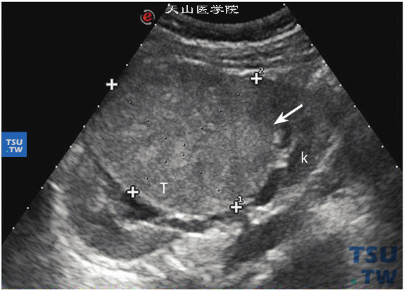 嫌色细胞型肾细胞癌超声图像特点：肾中部类圆形中等回声实性肿物，直径约7.10cm，肿物表面光滑，有完整包膜，外形规则，内部回声不均质，可见血流信号，肿物压迫肾盂轻度积水。肾静脉及下腔静脉未见瘤栓，肾门旁及腹膜后未见肿大淋巴结。此病例肿物体积大于7cm，回声较透明细胞癌略偏强，临床分期符合T2N0V0Mx期。病理结果：肾细胞癌，嫌色细胞型，部分出血变性