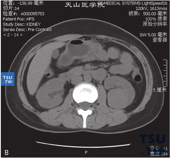 图B：CT，嫌色细胞型肾细胞癌，男，41岁，体检左肾占位。左肾见一略高密度灶，密度均匀，边缘清晰，增强后明显均匀强化，实质期密度较低