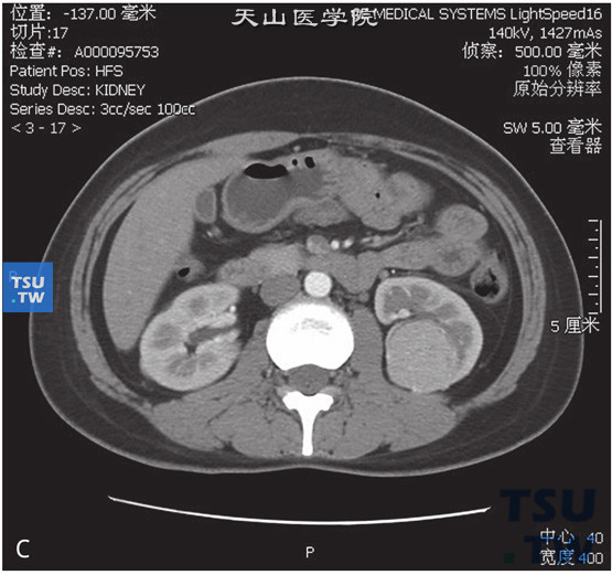 图C：CT，嫌色细胞型肾细胞癌，男，41岁，体检左肾占位。左肾见一略高密度灶，密度均匀，边缘清晰，增强后明显均匀强化，实质期密度较低