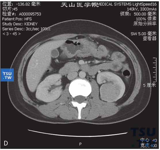 图D：CT，嫌色细胞型肾细胞癌，男，41岁，体检左肾占位。左肾见一略高密度灶，密度均匀，边缘清晰，增强后明显均匀强化，实质期密度较低