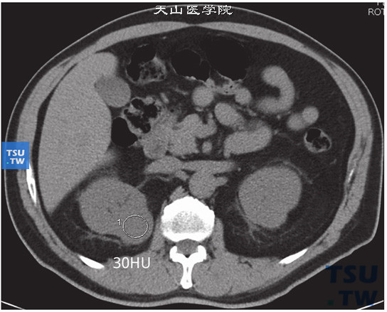 CT与MR对比，右肾嫌色细胞癌图1，右肾肿瘤平扫CT参考值约30HU