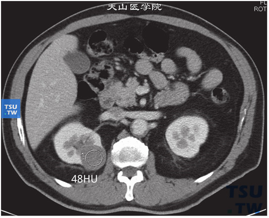CT与MR对比，右肾嫌色细胞癌图2，右肾肿瘤皮髓质期CT参考值约48HU