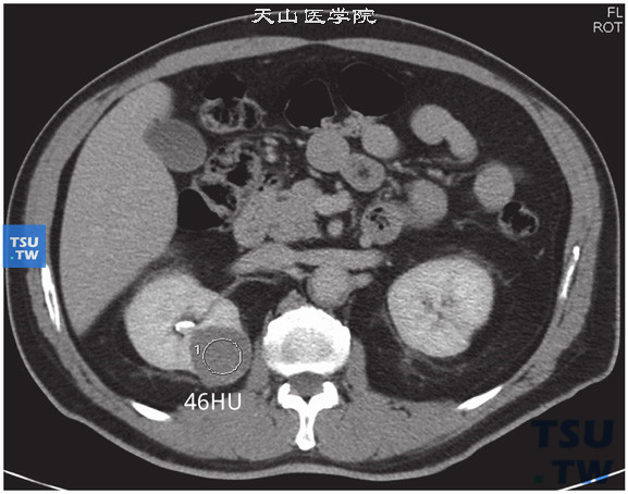 CT与MR对比，右肾嫌色细胞癌图3，右肾肿瘤排泄期CT参考值约46HU