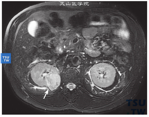 CT与MR对比，右肾嫌色细胞癌图4，T2压脂序列肿瘤呈不均匀稍高信号