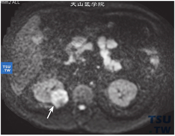 CT与MR对比，右肾嫌色细胞癌图5，DWI肿瘤呈明显高信号