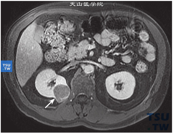 CT与MR对比，右肾嫌色细胞癌图6，增强肿瘤轻度强化