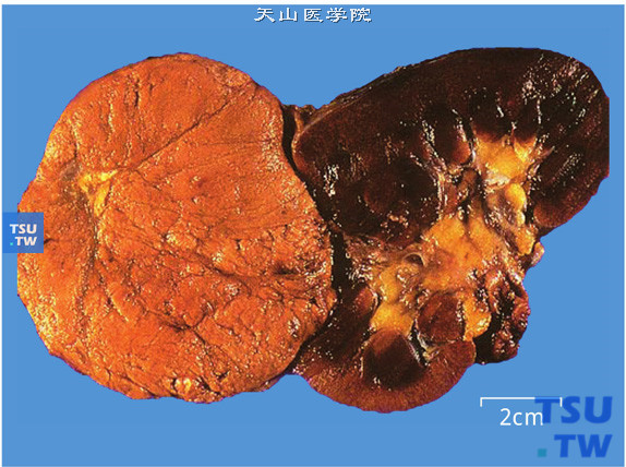 嫌色细胞型肾细胞癌（大体）。肿瘤呈球状，黄褐色，境界清楚，与嗜酸细胞瘤相似