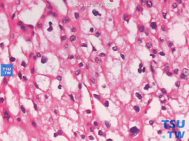 嫌色细胞型肾细胞癌，示核沟
