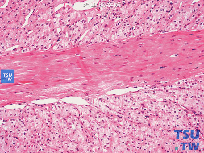 嗜酸型嫌色细胞性肾细胞癌，胞质嗜酸，胞膜清晰，可见核周空晕。并可见宽厚的纤维间隔