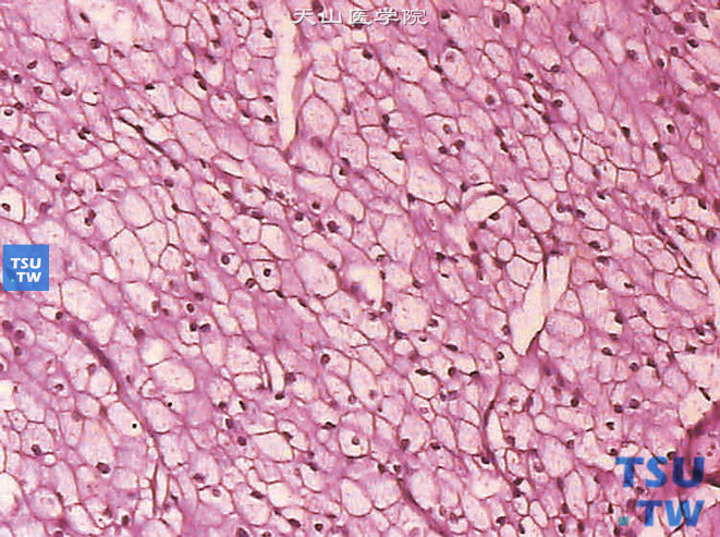 嫌色细胞型肾细胞癌。示清晰的胞膜