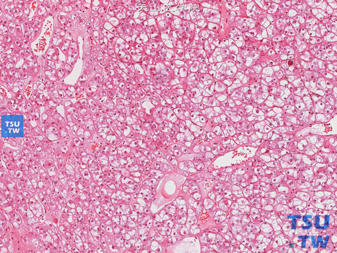 肾细胞癌，嫌色细胞型，示细胞膜非常清晰，胞质透明略呈网状