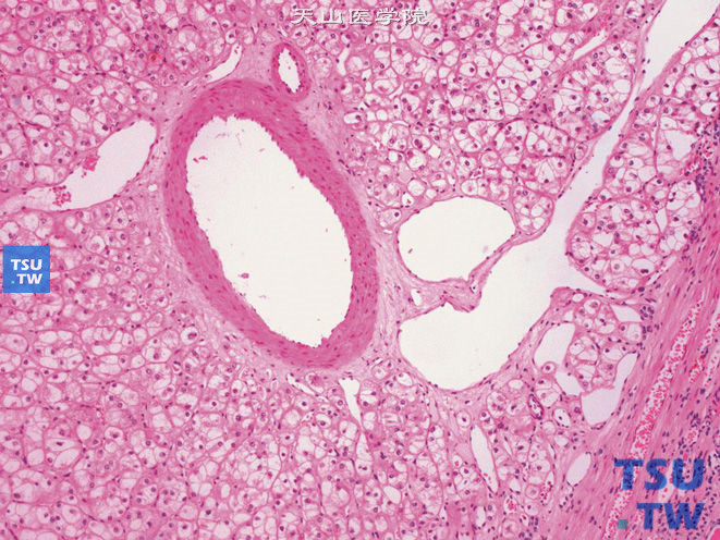 肾细胞癌，嫌色细胞型，示厚壁血管