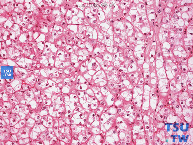 肾细胞癌，嫌色细胞型，示核皱褶及小核仁