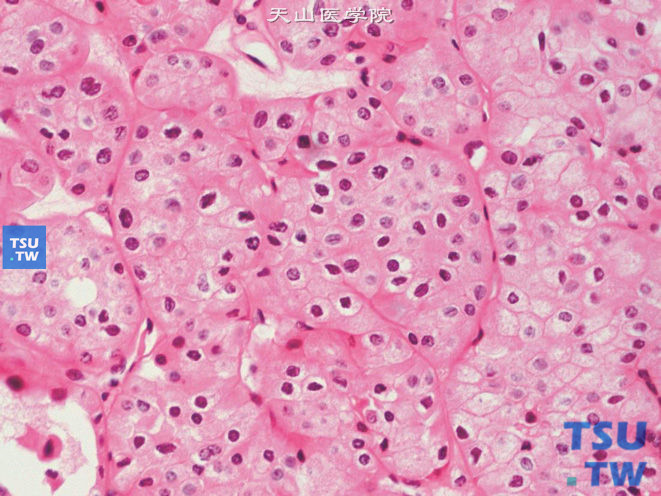 嗜酸型嫌色细胞性肾细胞癌，示细胞膜清晰，可见核皱褶（图中央）及核分裂象