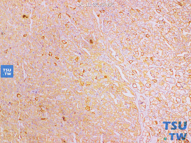 嫌色性肾细胞癌，嗜酸细胞型。广谱CK（+）