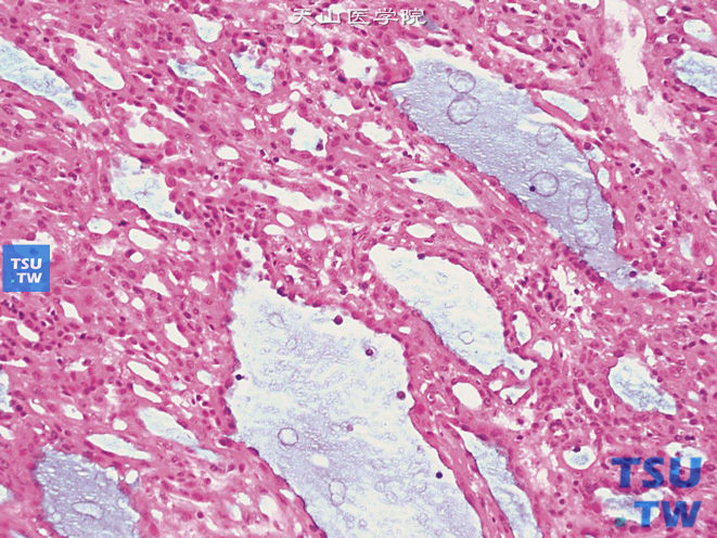 恶性肿瘤：肾黏液样小管状和梭形细胞癌