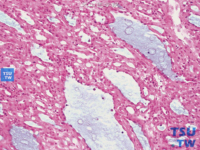 肾黏液样小管状及梭形细胞癌，示部分细胞略呈梭形