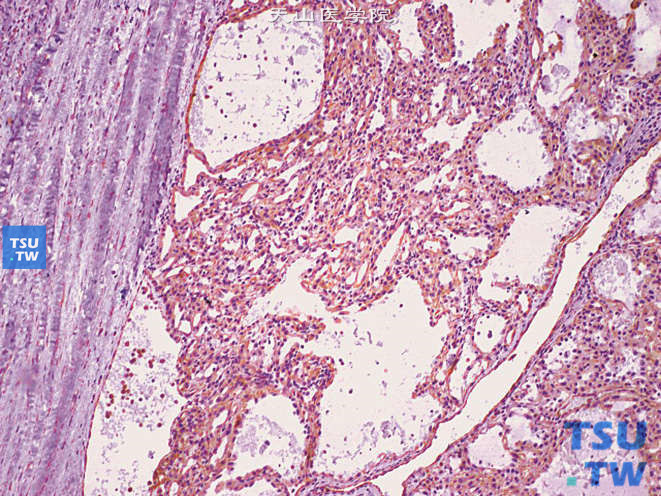 肾黏液样小管状及梭形细胞癌，示VIM+