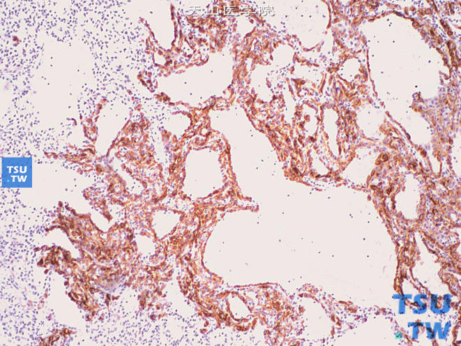 肾黏液样小管状及梭形细胞癌，示CK19部分+
