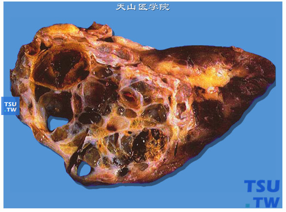 肾多房囊性肾细胞癌（大体）。切面有大小不等的囊腔，囊壁很薄