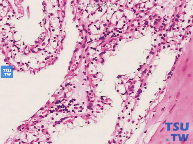 多房囊性肾细胞癌。肿瘤呈多囊性结构，囊壁为透明细胞