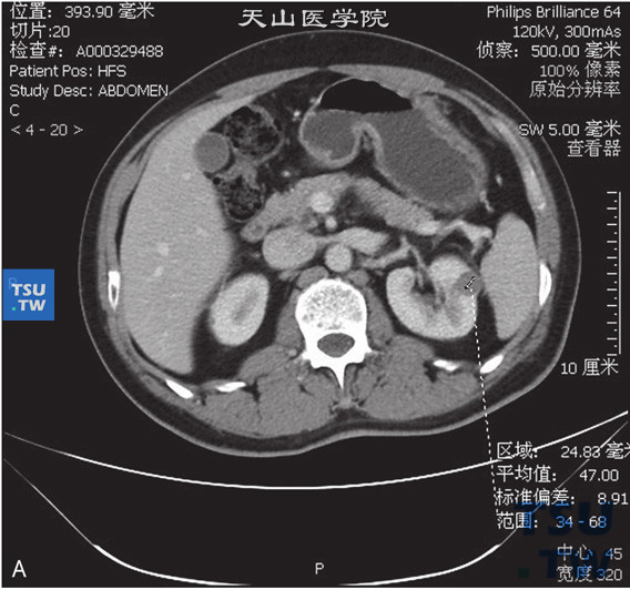图A：CT乳头状肾癌，男，79岁，体检发现左肾占位。CT发现左肾前上段一结节状等密度灶，边缘清晰，部分突出于肾实质外。增强扫描皮质期可见轻度强化，实质期及延时期可见病灶持续强化。平扫及增强后皮质期、实质期及分泌期CT值分别为29HU、34HU、47HU及48HU