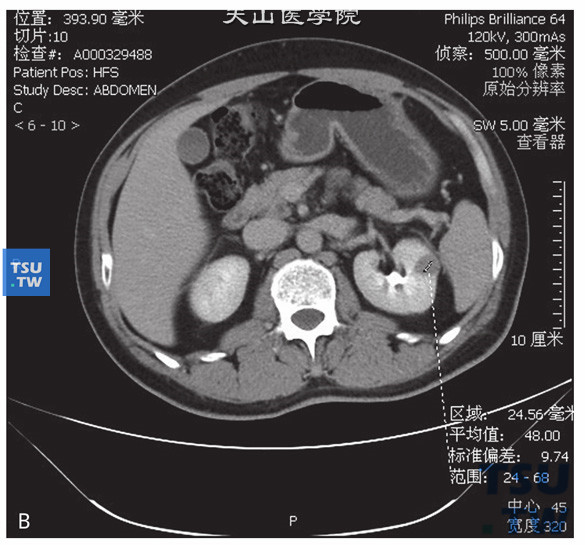 图B：CT乳头状肾癌，男，79岁，体检发现左肾占位。CT发现左肾前上段一结节状等密度灶，边缘清晰，部分突出于肾实质外。增强扫描皮质期可见轻度强化，实质期及延时期可见病灶持续强化。平扫及增强后皮质期、实质期及分泌期CT值分别为29HU、34HU、47HU及48HU