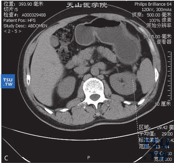 图C：CT乳头状肾癌，男，79岁，体检发现左肾占位。CT发现左肾前上段一结节状等密度灶，边缘清晰，部分突出于肾实质外。增强扫描皮质期可见轻度强化，实质期及延时期可见病灶持续强化。平扫及增强后皮质期、实质期及分泌期CT值分别为29HU、34HU、47HU及48HU