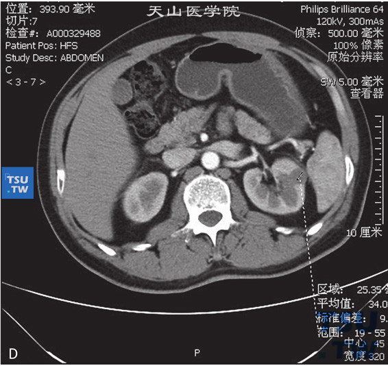 图C：CT乳头状肾癌，男，79岁，体检发现左肾占位。CT发现左肾前上段一结节状等密度灶，边缘清晰，部分突出于肾实质外。增强扫描皮质期可见轻度强化，实质期及延时期可见病灶持续强化。平扫及增强后皮质期、实质期及分泌期CT值分别为29HU、34HU、47HU及48HU