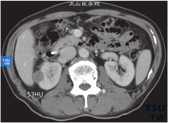 CT与MR对比，右肾乳头状肾细胞癌，实质期CT参考值约53HU（1）