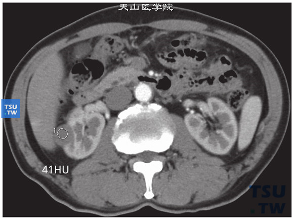 CT与MR对比，右肾乳头状肾细胞癌，皮髓质期CT参考值约41HU（2）