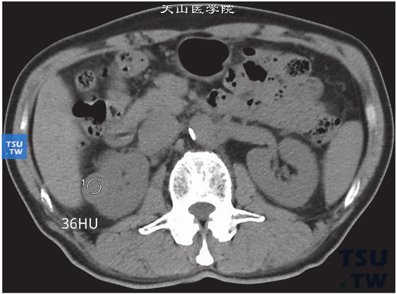 CT与MR对比，右肾乳头状肾细胞癌，平扫CT参考值约36HU（3）