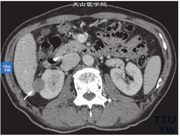 CT与MR对比，右肾乳头状肾细胞癌，CT增强实质期右肾类圆形病变（4）