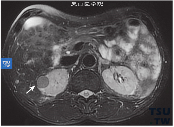 CT与MR对比，右肾乳头状肾细胞癌，T2压脂序列 肿瘤呈稍低信号，明显区别于囊肿（T2WI高信号）（6）