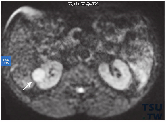 CT与MR对比，右肾乳头状肾细胞癌，DWI肿瘤呈高信号（7）