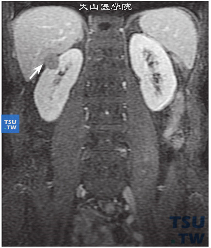 CT与MR对比，右肾乳头状肾细胞癌，DWI增强肿瘤轻度强化（8）