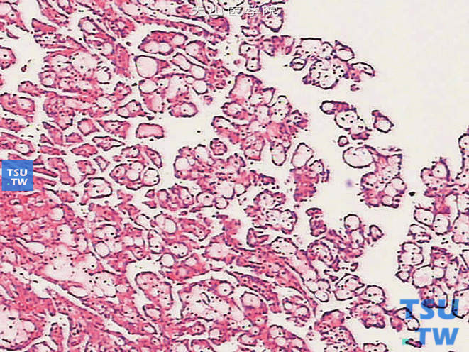 肾乳头状肾细胞癌，Ⅰ型。乳头表面被覆单层肿瘤细胞，癌细胞小，胞质少。乳头轴心可见大量泡沫细胞