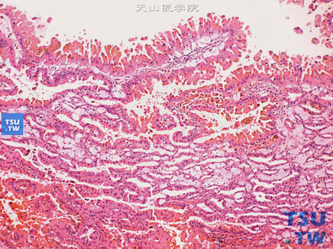 乳头状肾细胞癌，Ⅱ型。示高柱状细胞中的含铁血黄素