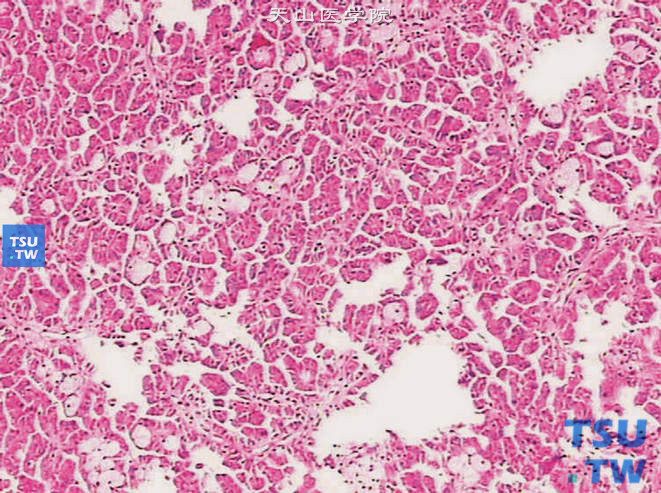 乳头状肾细胞癌Ⅱ型，瘤细胞呈假复层排列，胞质嗜酸。乳头间质可见泡沫细胞